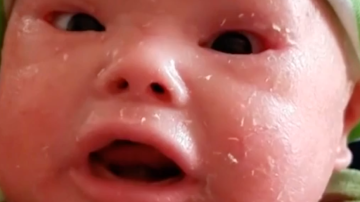 Bebé con la enfermedad congénita ictiosis del Arlequín.