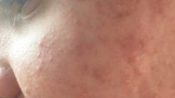 El acné quístico de un adolecente con autismo.