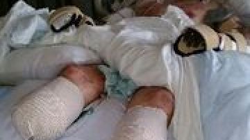 Greg Manteufel en la cama del hospital después de la amputación de piernas y manos.