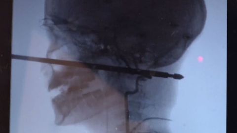Pincho cabeza niño