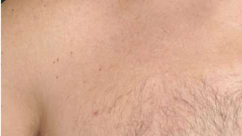 Nadie está exento del cáncer mamario