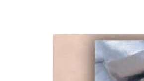 El mioma gigante de la mujer.