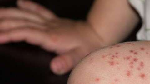 Los niños son especialmente vulnerables al sarampión. (archive)