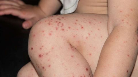 Los niños son especialmente vulnerables al sarampión. (archive)