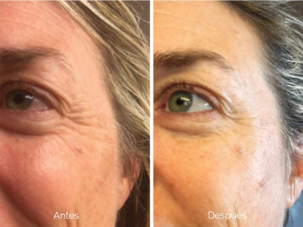 8 Cremas Para Las Arrugas Que Harán Que Nunca Necesites Botox La Opinión