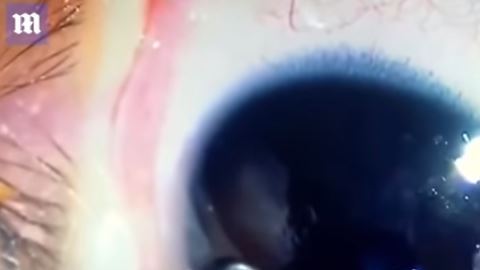 Gusanos ojo bebé