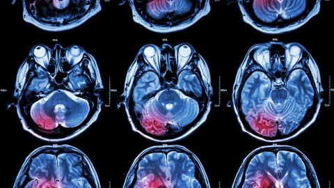 Investigan relación de derrames cerebrales con COVID-19.