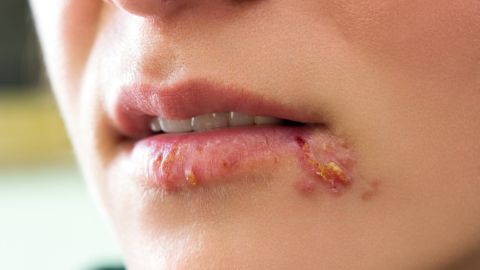 herpes labial