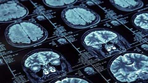 cerebro