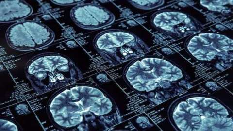 cerebro