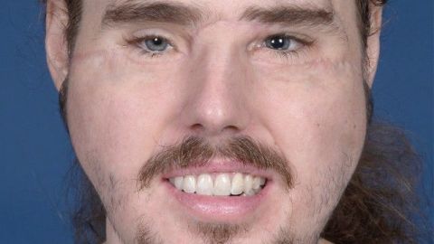 Cameron Underwood con el rostro reconstruido