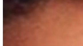 La joven contrajo una infección por querer agrandarse los labios.