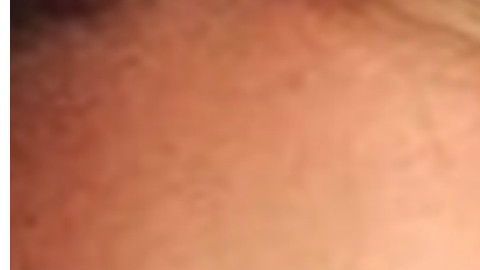 La joven contrajo una infección por querer agrandarse los labios.