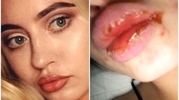 La joven contrajo una infección por querer agrandarse los labios.