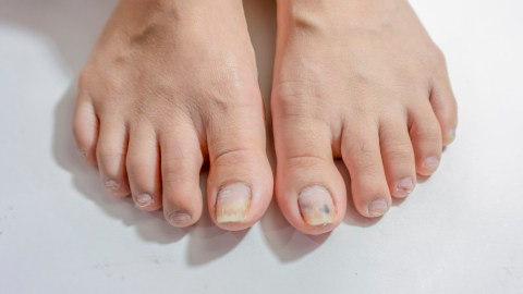 hongos uñas pies