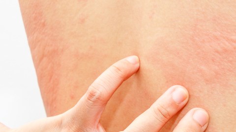 urticaria
