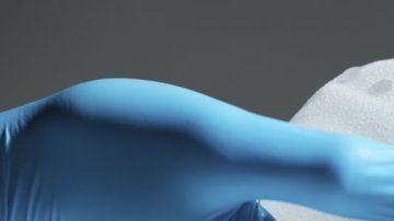 El Linfoma Anaplásico de Células Grandes asociado a implantes de mama es un tipo de cáncer raro.