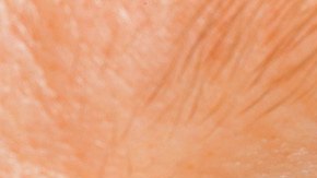 glaucoma