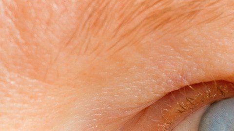 glaucoma