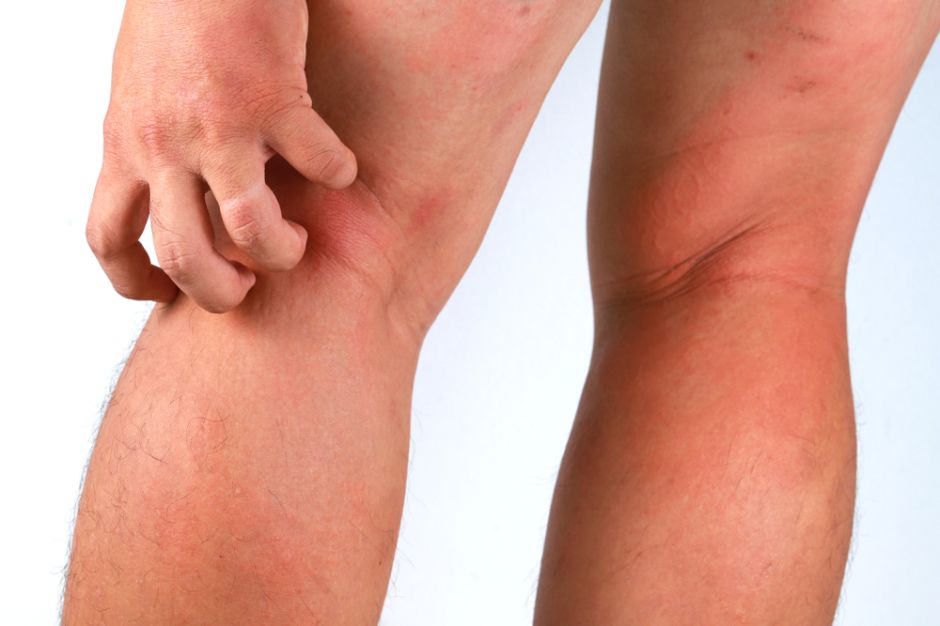 irritación entre las piernas