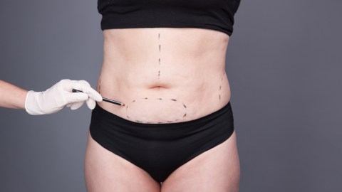 abdominoplastia