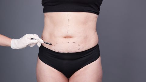 abdominoplastia