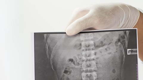 ankylosing-spondylitis