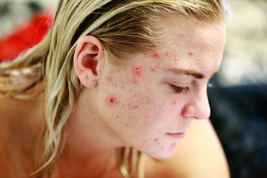 como quitar el acne en el cuerpo como quitar el acne en el cuerpo