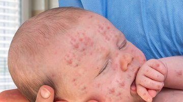 Menos personas vacunadas, una de las causas de los brotes de sarampión.