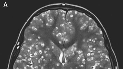 El cerebro del muchacho con larvas de gusano.