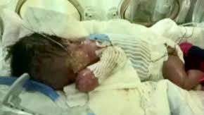 El niño Ja’bari Gray nació el 1 de enero del 2019 con la rara enfermedad Aplasia Cutis.