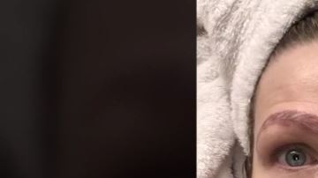 Este fue el terrible resultado de un mal procedimiento.