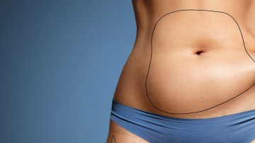 liposuccion