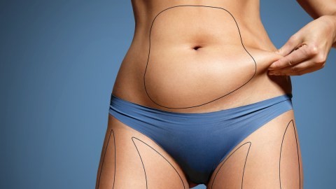 liposuccion