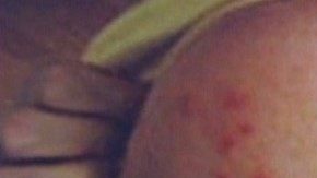 Primer caso de sarampión confirmado en Dallas.