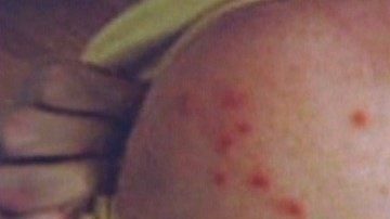 Primer caso de sarampión confirmado en Dallas.