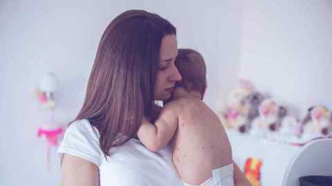 No solo los niños pueden contraer el sarampión. Los adultos están en riesgo también.