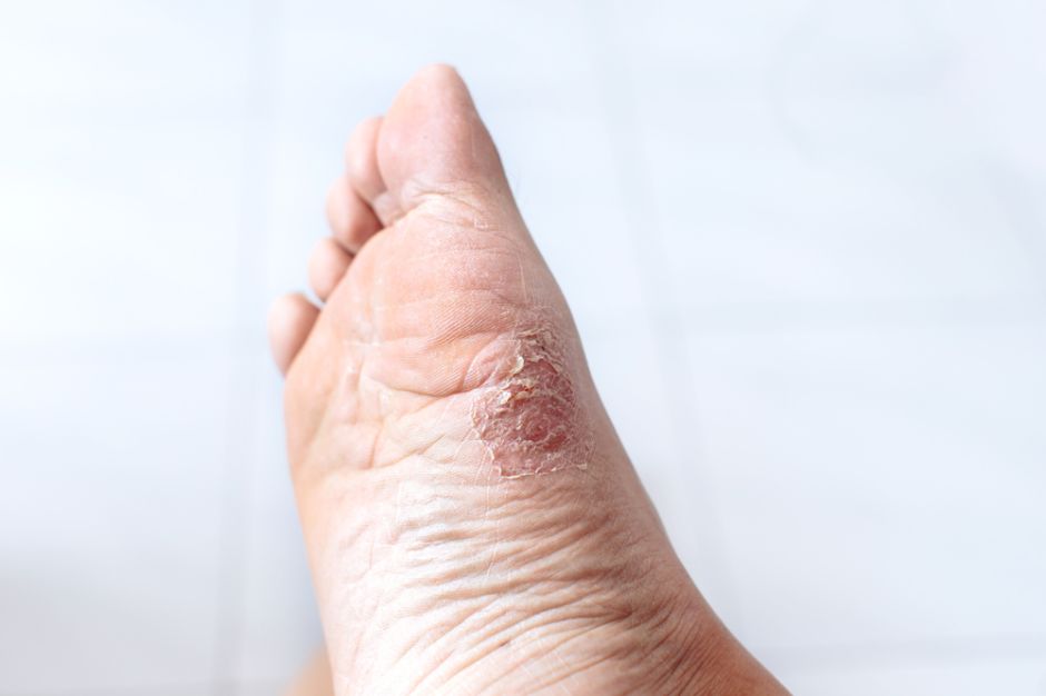 ¿Lamisil cura las infecciones por hongos?