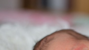 malformaciones vasculares