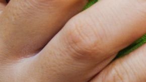 Declaran alerta por sarampión en Los Ángeles.