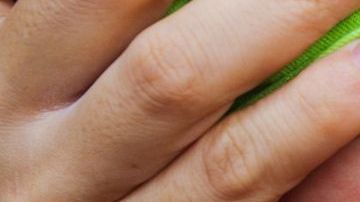 Declaran alerta por sarampión en Los Ángeles.