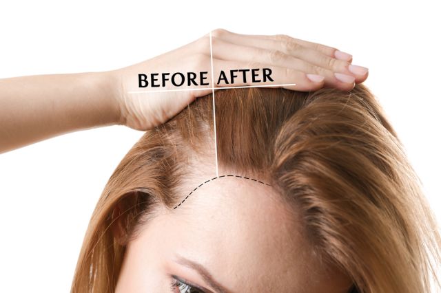 Los 3 tratamientos para la caída del cabello por internet La Opinión