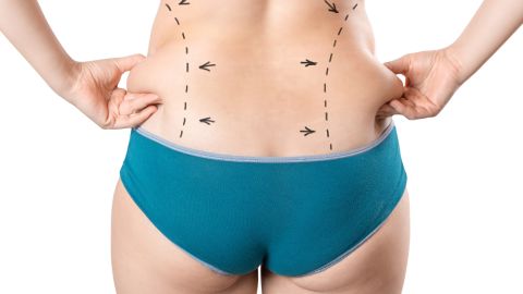 Liposucción