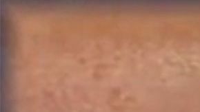 La pierna con las mordidas.