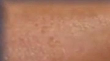 La pierna con las mordidas.