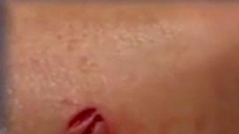 La pierna con las mordidas.