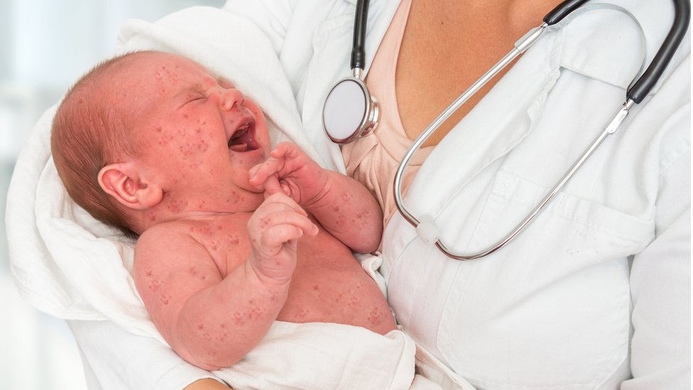 Sarampión: 6 cosas que debes saber sobre la vacuna contra este virus