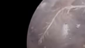 El insecto se resistió a dejar el cuerpo de esta persona.