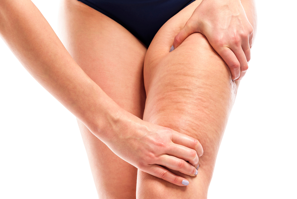 Los 6 mejores productos para la celulitis de tus piernas - La Opinión