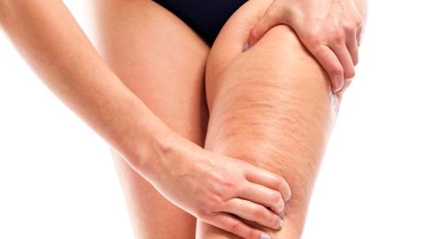 celulitis piernas